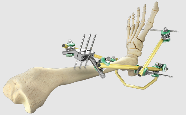 External Fixation and Traction Equipment