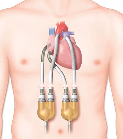 Implantable Circulation Aid