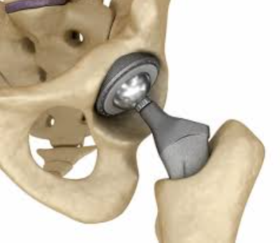 Joint Replacement Implant