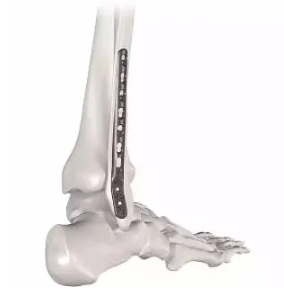 Osteosynthesis Implant