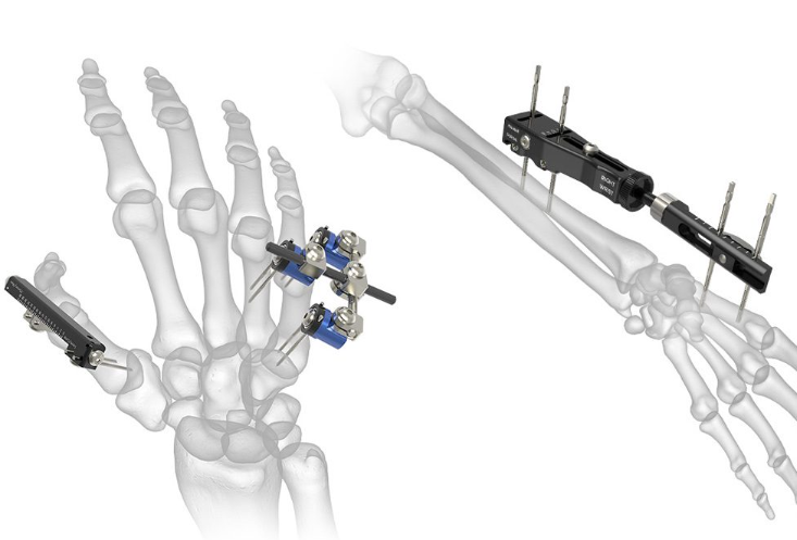 Single and Multi-component Metal Bone Fixation Apparatus and Accessory