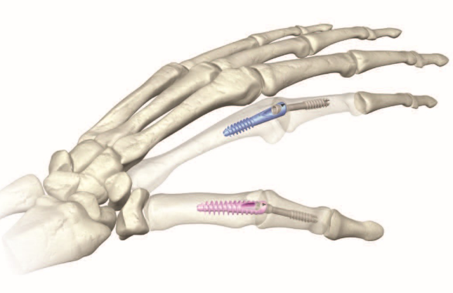 Single and Multiple-components Absorbable Bone Fixation Apparatus