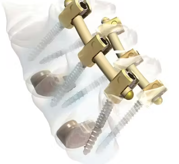 Spinal Implant