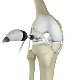 Sports Injury Soft Tissue Repair Reconstruction Implant
