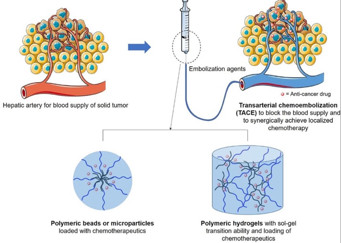 Schematic illustration of design of transarterial chemoembolization (TACE) agents.