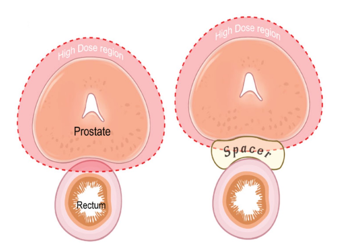 The application of hydrogel spacer in prostate radiotherapy.