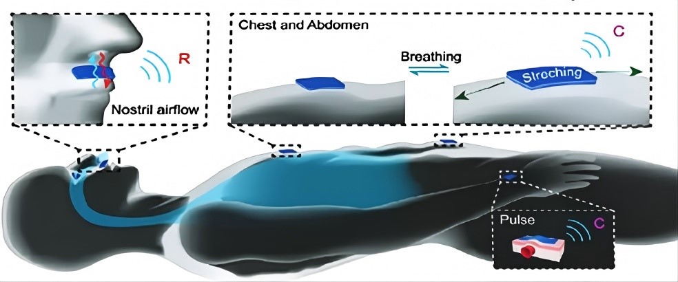 Smart hydrogel-based sensors monitor respiratory applied to the nostril, chest, and abdomen, respectively.