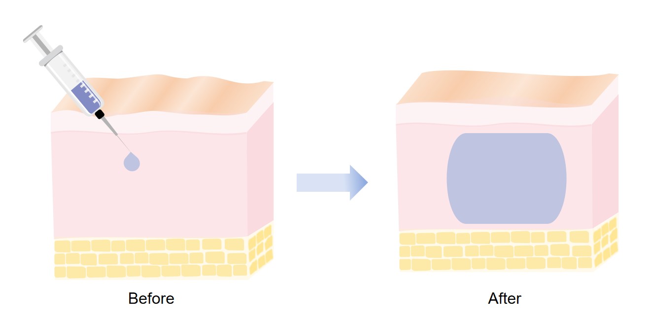 Hydrogel dermal filler. (STEMart original)
